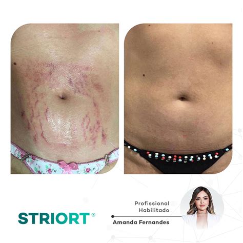 striort antes e depois|striort pdf.